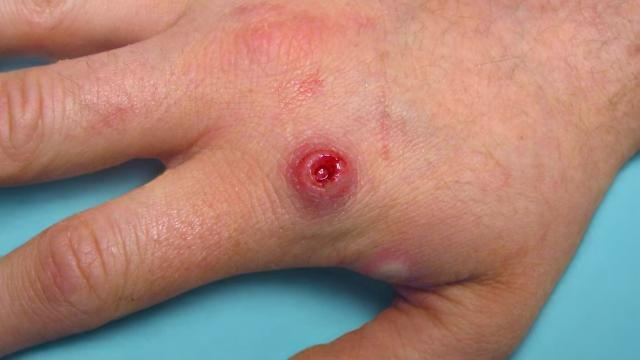 Monkeypox begrijpen en hoe u dit kunt voorkomen？